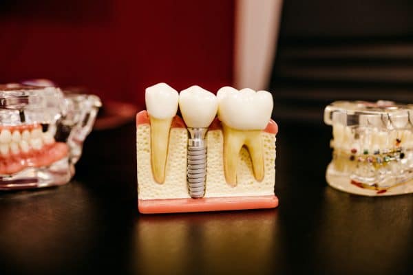 Comment tient un dentier du haut ?